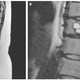 Above, the tapeworm cyst-caused lesion that caused a 35-year-old French woman to lose sensation and feel painful shocks in both her legs.